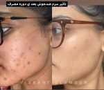 سرم ضد جوش چای سبز ويبرانت گلامور
